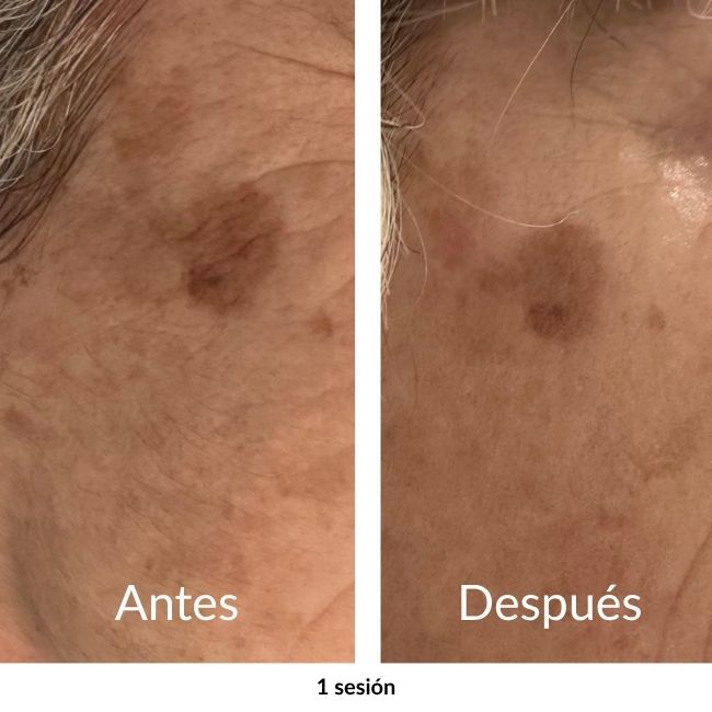 antes y despues de uso de exosomas en madrid